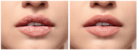 3 Causes of Chapped Lips Due to Dryness