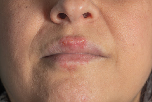 Understanding and Managing Red, Burning Lips