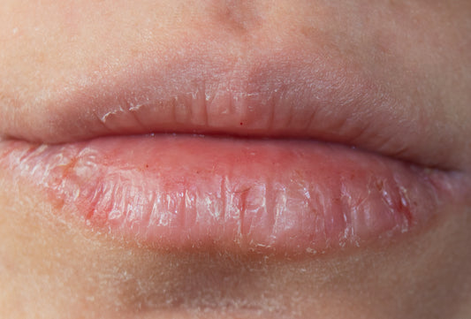 Painful Dry Lips: Causes and Solutions