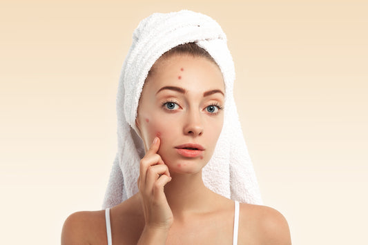 How to Remove Dark Spots Caused by Pimples
